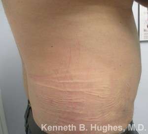 Male Liposuction Before & After Patient #9731