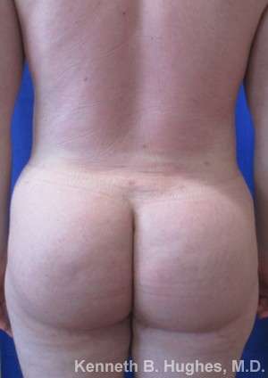 Male Liposuction Before & After Patient #9734