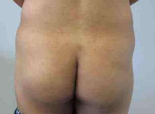 Male Liposuction Before & After Patient #9740