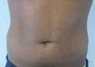 Male Liposuction Before & After Patient #9745