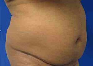 Male Liposuction Before & After Patient #9748
