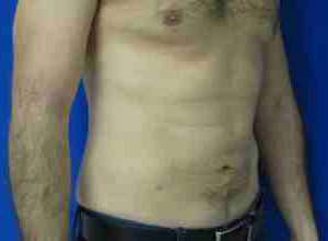 Male Liposuction Before & After Patient #9754