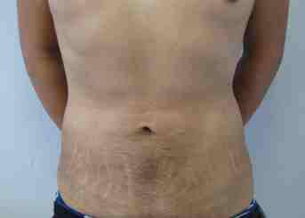 Male Liposuction Before & After Patient #9757