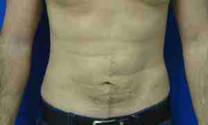 Male Liposuction Before & After Patient #9763