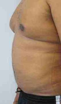 Male Liposuction Before & After Patient #9766