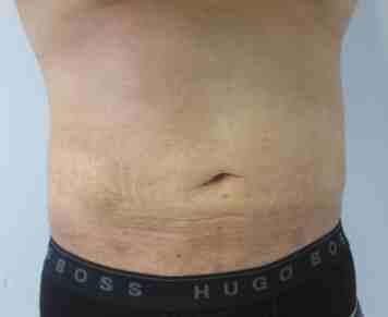 Male Liposuction Before & After Patient #9769