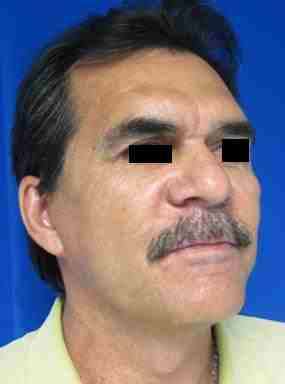Male Neck Lift Before & After Patient #9774