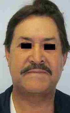 Male Neck Lift Before & After Patient #9779