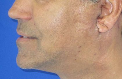 Male Neck Lift Before & After Patient #9782