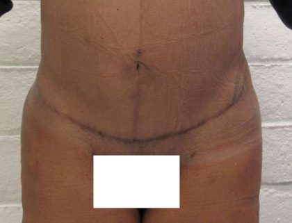 Brazilian Butt Lift Before & After Patient #6291