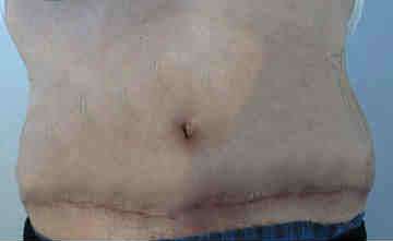 Male Tummy Tuck Before & After Patient #9788