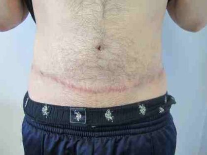 Male Tummy Tuck Before & After Patient #9791