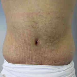 Male Tummy Tuck Before & After Patient #9794