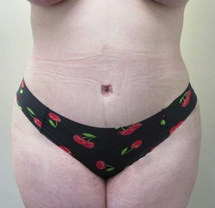 Mommy Makeover Before & After Patient #9797