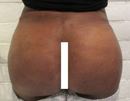 Brazilian Butt Lift Before & After Patient #6294