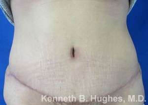 Mommy Makeover Before & After Patient #9837