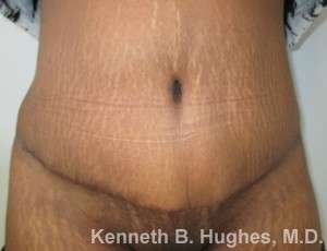 Mommy Makeover Before & After Patient #9840