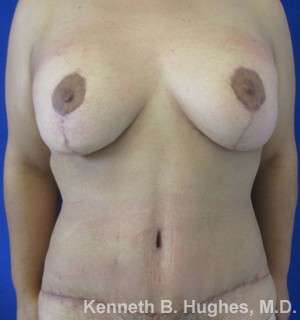 Mommy Makeover Before & After Patient #9854