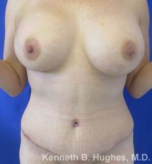 Mommy Makeover Before & After Patient #9857