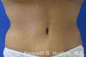 Mommy Makeover Before & After Patient #9869