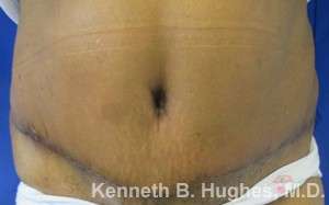 Mommy Makeover Before & After Patient #9872