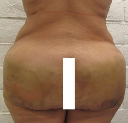 Brazilian Butt Lift Before & After Patient #6301