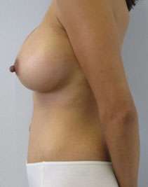 Mommy Makeover Before & After Patient #9908