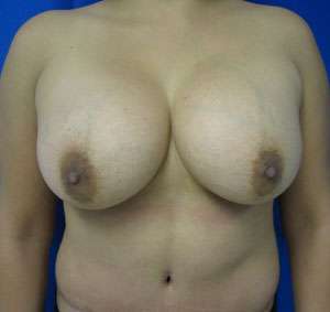 Mommy Makeover Before & After Patient #9914