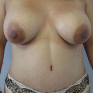 Mommy Makeover Before & After Patient #9920