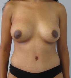 Mommy Makeover Before & After Patient #9923
