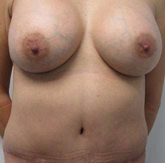 Mommy Makeover Before & After Patient #9926