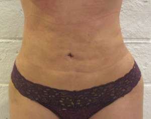 Abdomen Before & After Patient #5880