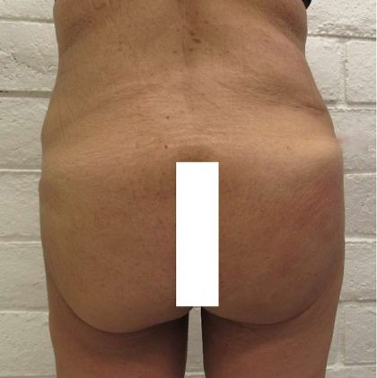 Brazilian Butt Lift Before & After Patient #6304