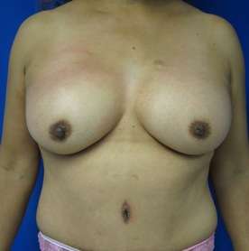 Mommy Makeover Before & After Patient #9929