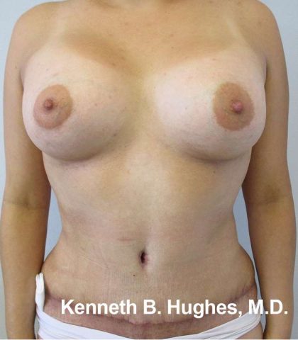 Mommy Makeover Before & After Patient #9941