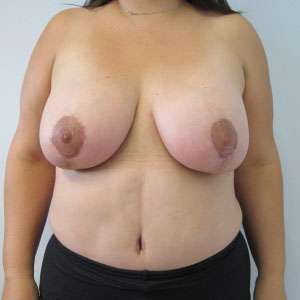 Mommy Makeover Before & After Patient #9947