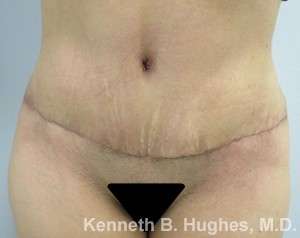 Mommy Makeover Before & After Patient #9957