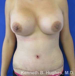 Mommy Makeover Before & After Patient #9960