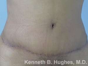 Mommy Makeover Before & After Patient #9969