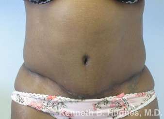 Mommy Makeover Before & After Patient #9977