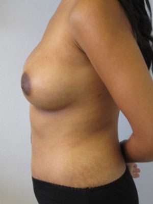 Mommy Makeover Before & After Patient #9989