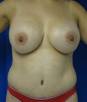 Mommy Makeover Before & After Patient #9995