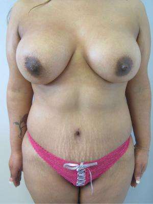 Mommy Makeover Before & After Patient #9998