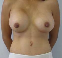 Mommy Makeover Before & After Patient #10001