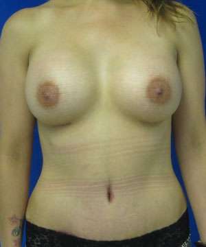 Mommy Makeover Before & After Patient #10009