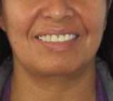 Neck Lift Before & After Patient #10021