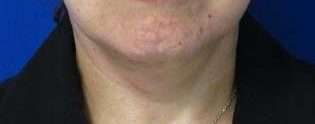 Neck Lift Before & After Patient #10026