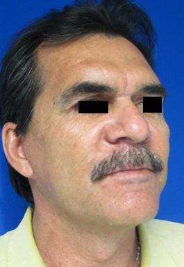 Neck Lift Before & After Patient #10031