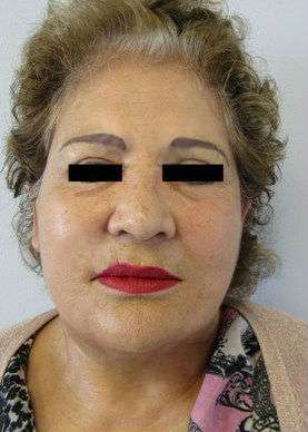 Neck Lift Before & After Patient #10044