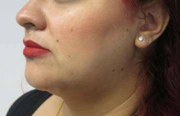 Neck Lift Before & After Patient #10049